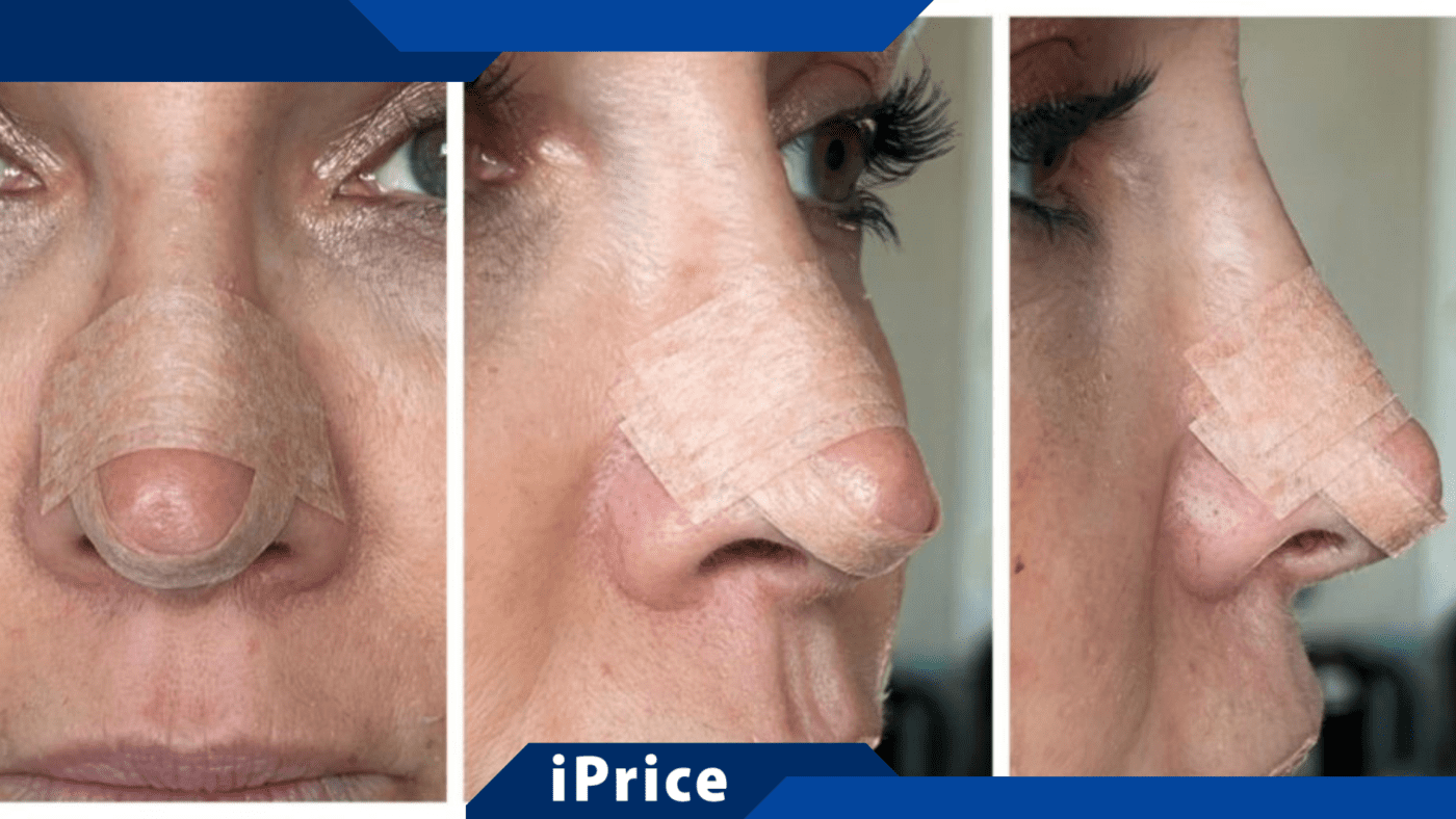 Combien Co Te Une Rhinoplastie Guide Complet Sur Les Tarifs Et